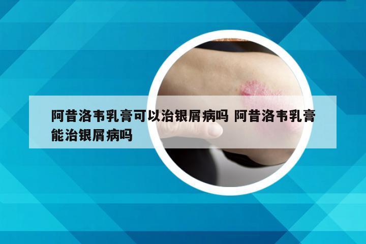 阿昔洛韦乳膏可以治银屑病吗 阿昔洛韦乳膏能治银屑病吗