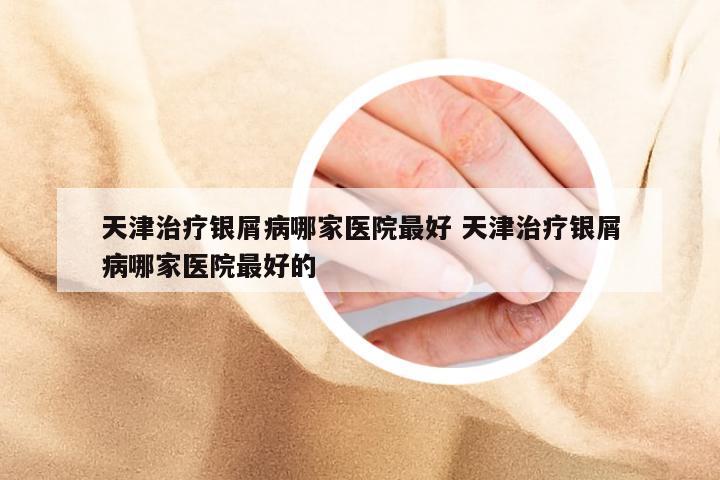 天津治疗银屑病哪家医院最好 天津治疗银屑病哪家医院最好的
