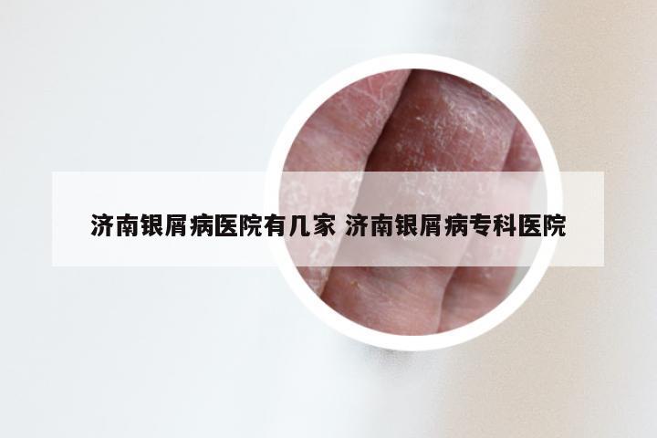 济南银屑病医院有几家 济南银屑病专科医院