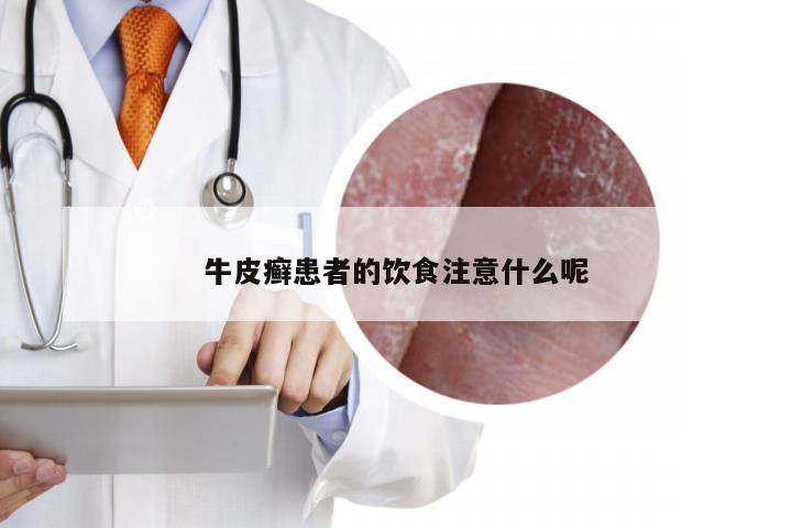 牛皮癣患者的饮食注意什么呢