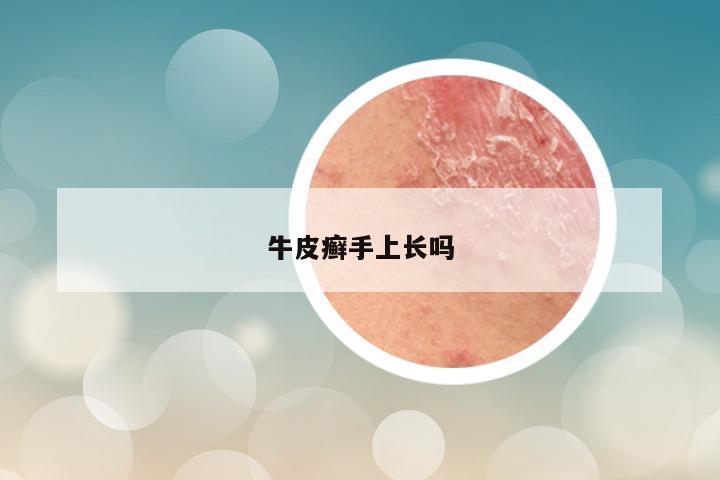 牛皮癣手上长吗