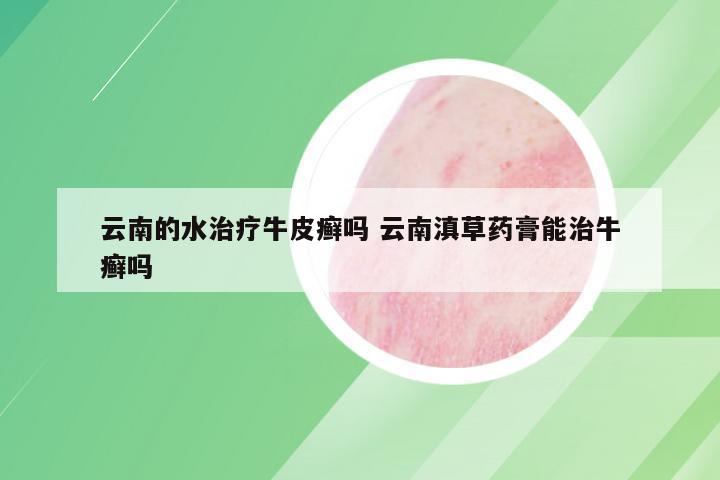 云南的水治疗牛皮癣吗 云南滇草药膏能治牛癣吗
