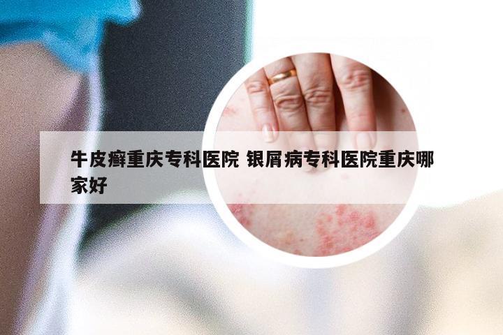牛皮癣重庆专科医院 银屑病专科医院重庆哪家好