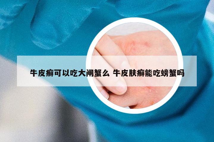 牛皮癣可以吃大闸蟹么 牛皮肤癣能吃螃蟹吗