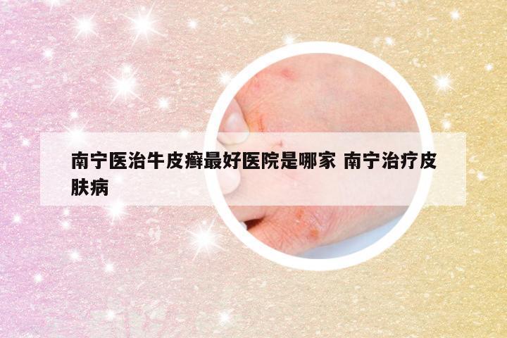 南宁医治牛皮癣最好医院是哪家 南宁治疗皮肤病