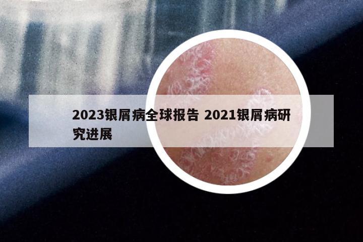 2023银屑病全球报告 2021银屑病研究进展