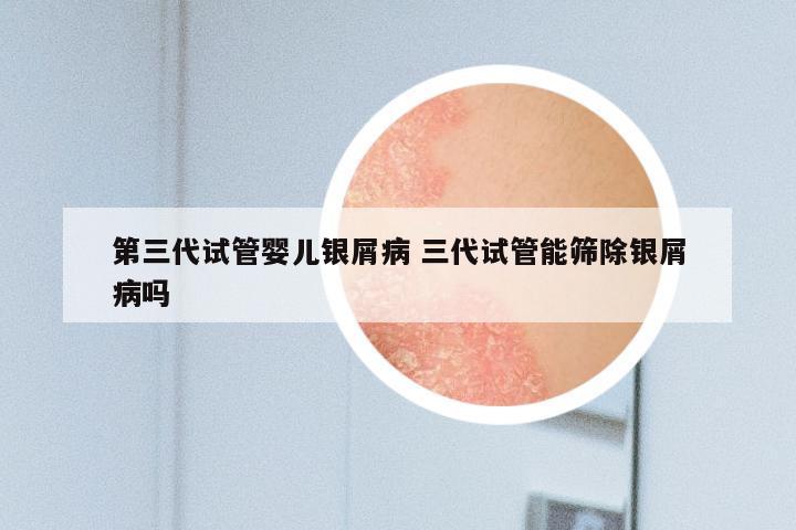 第三代试管婴儿银屑病 三代试管能筛除银屑病吗