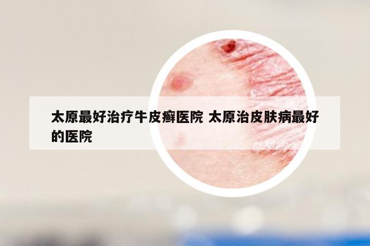 太原最好治疗牛皮癣医院 太原治皮肤病最好的医院