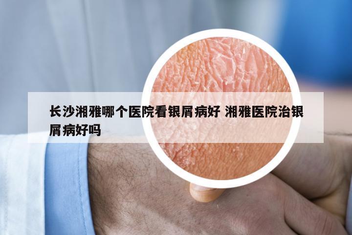 长沙湘雅哪个医院看银屑病好 湘雅医院治银屑病好吗