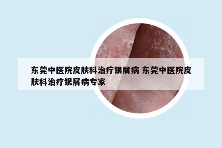 东莞中医院皮肤科治疗银屑病 东莞中医院皮肤科治疗银屑病专家