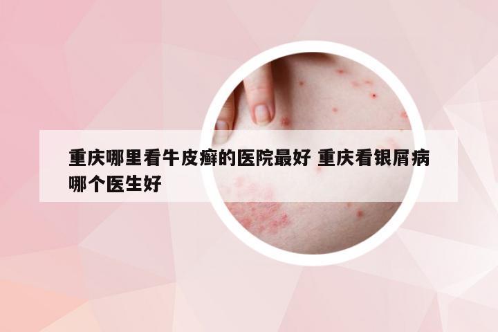 重庆哪里看牛皮癣的医院最好 重庆看银屑病哪个医生好