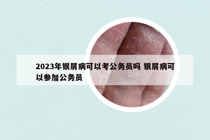 2023年银屑病可以考公务员吗 银屑病可以参加公务员