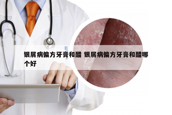 银屑病偏方牙膏和醋 银屑病偏方牙膏和醋哪个好