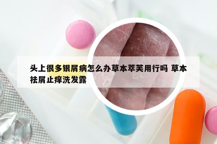 头上很多银屑病怎么办草本萃芙用行吗 草本祛屑止痒洗发露