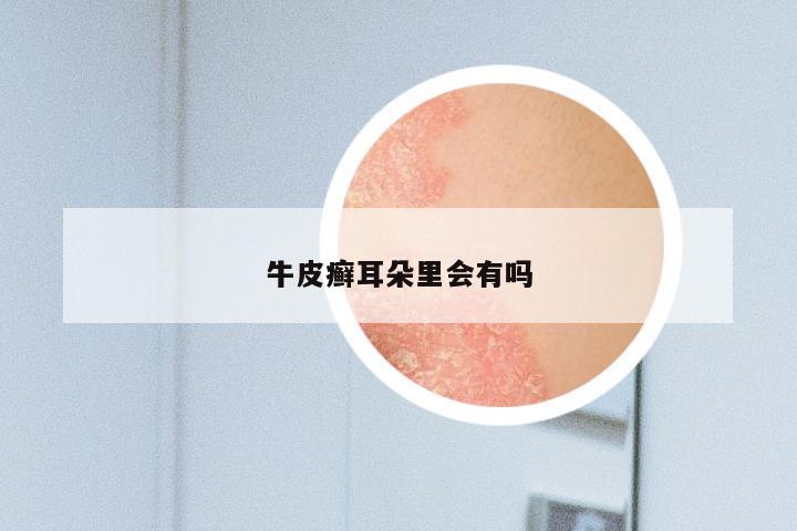 牛皮癣耳朵里会有吗