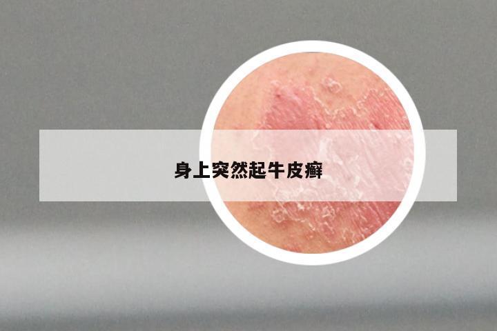 身上突然起牛皮癣