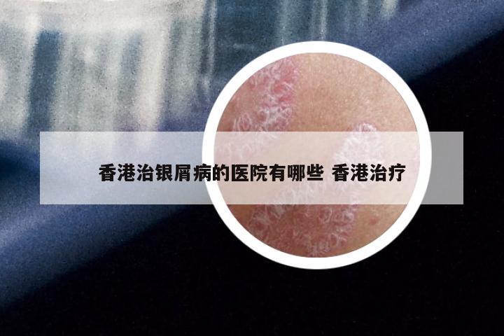香港治银屑病的医院有哪些 香港治疗