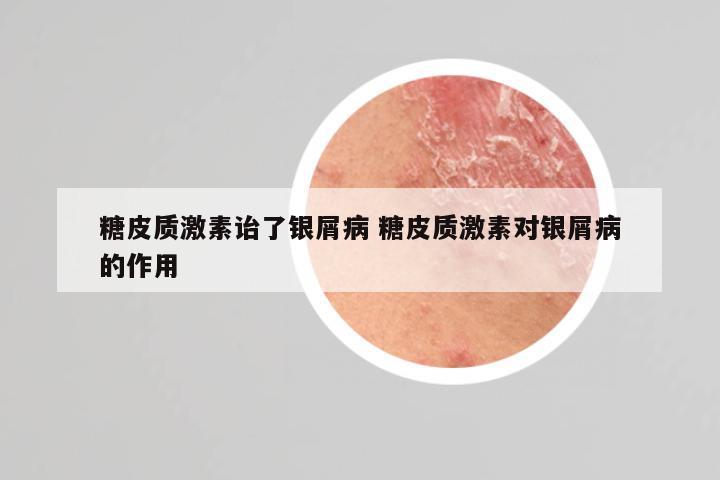 糖皮质激素诒了银屑病 糖皮质激素对银屑病的作用