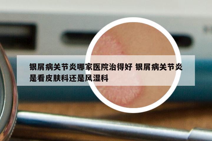 银屑病关节炎哪家医院治得好 银屑病关节炎是看皮肤科还是风湿科