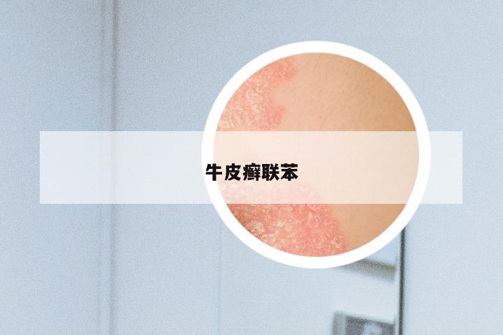 牛皮癣联苯