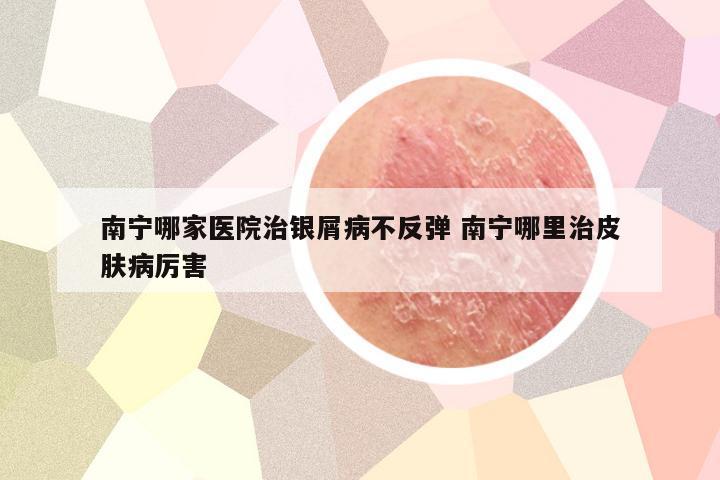 南宁哪家医院治银屑病不反弹 南宁哪里治皮肤病厉害