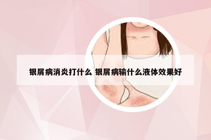 银屑病消炎打什么 银屑病输什么液体效果好
