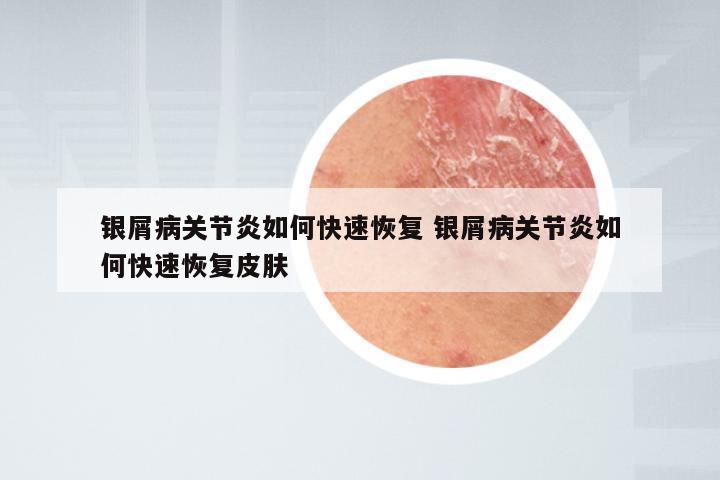 银屑病关节炎如何快速恢复 银屑病关节炎如何快速恢复皮肤