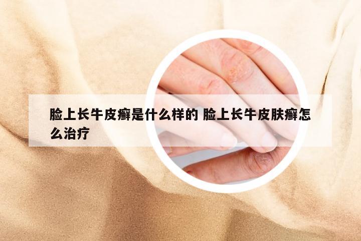 脸上长牛皮癣是什么样的 脸上长牛皮肤癣怎么治疗