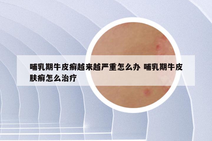 哺乳期牛皮癣越来越严重怎么办 哺乳期牛皮肤癣怎么治疗