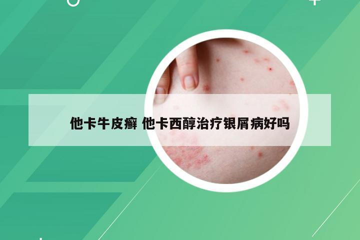 他卡牛皮癣 他卡西醇治疗银屑病好吗