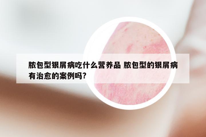脓包型银屑病吃什么营养品 脓包型的银屑病有治愈的案例吗?