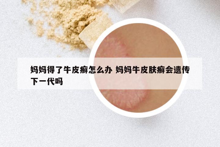 妈妈得了牛皮癣怎么办 妈妈牛皮肤癣会遗传下一代吗