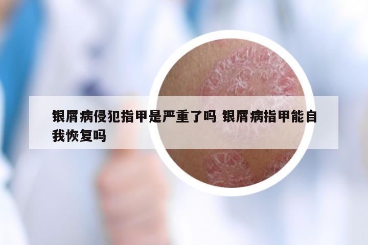 银屑病侵犯指甲是严重了吗 银屑病指甲能自我恢复吗