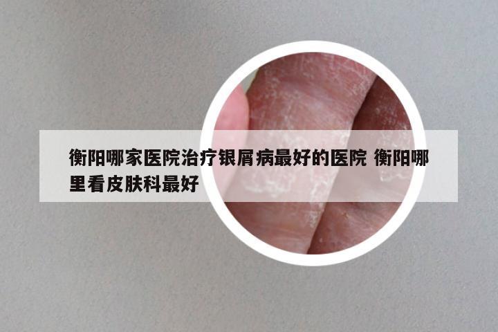 衡阳哪家医院治疗银屑病最好的医院 衡阳哪里看皮肤科最好