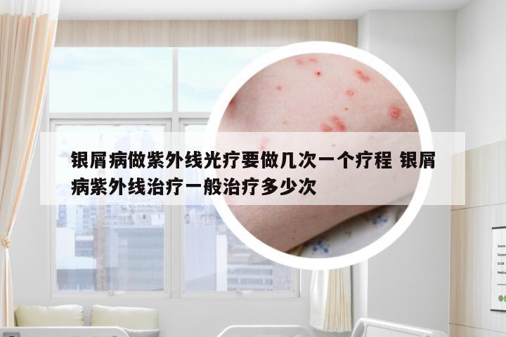 银屑病做紫外线光疗要做几次一个疗程 银屑病紫外线治疗一般治疗多少次