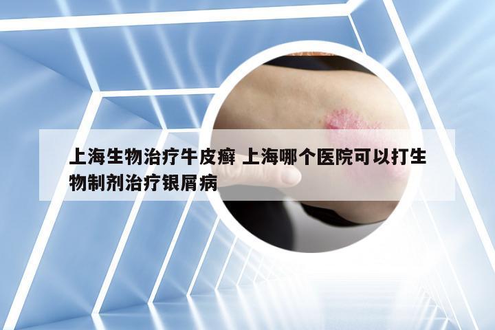 上海生物治疗牛皮癣 上海哪个医院可以打生物制剂治疗银屑病