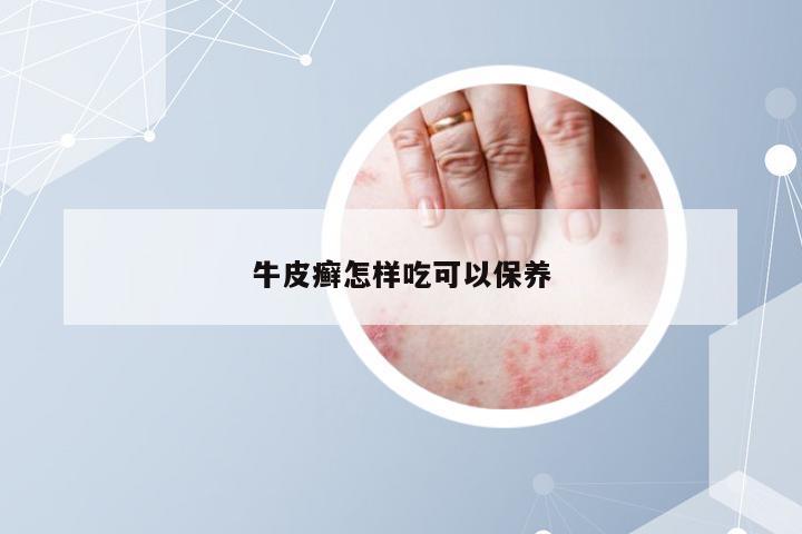 牛皮癣怎样吃可以保养