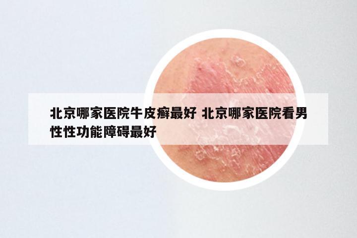 北京哪家医院牛皮癣最好 北京哪家医院看男性性功能障碍最好