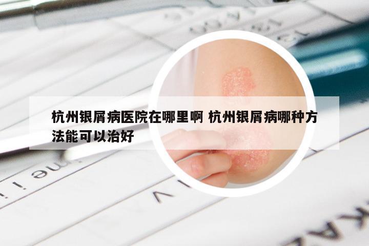 杭州银屑病医院在哪里啊 杭州银屑病哪种方法能可以治好
