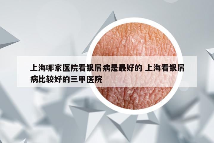 上海哪家医院看银屑病是最好的 上海看银屑病比较好的三甲医院