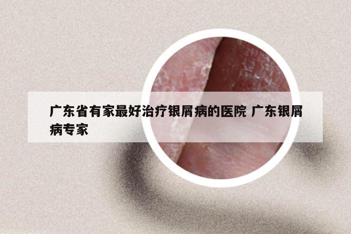 广东省有家最好治疗银屑病的医院 广东银屑病专家