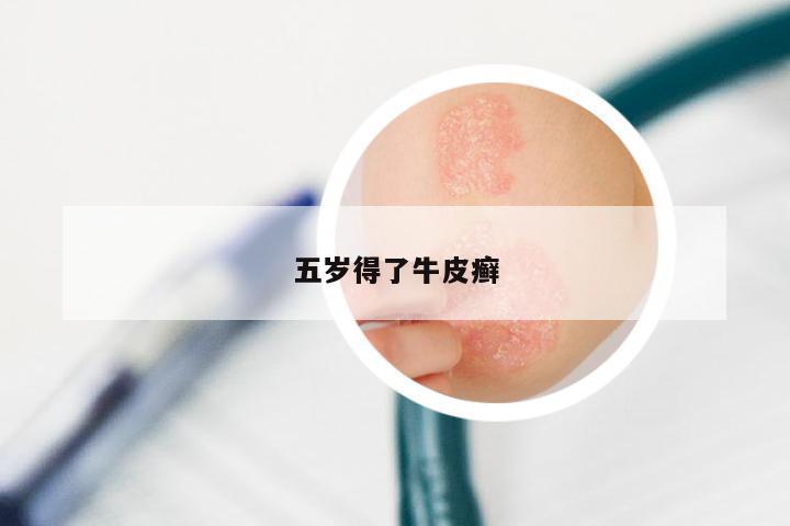五岁得了牛皮癣