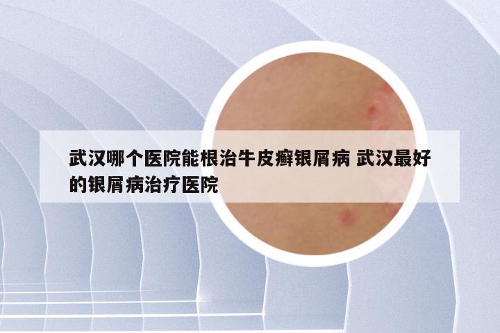 武汉哪个医院能根治牛皮癣银屑病 武汉最好的银屑病治疗医院