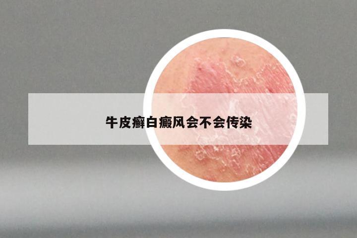 牛皮癣白癜风会不会传染