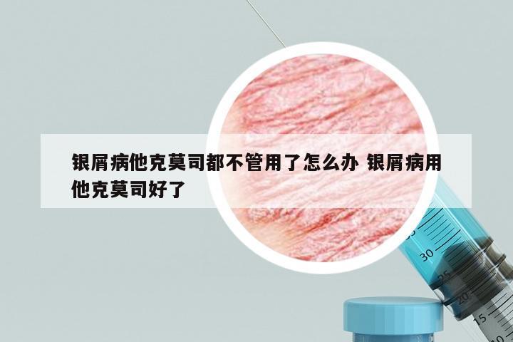 银屑病他克莫司都不管用了怎么办 银屑病用他克莫司好了