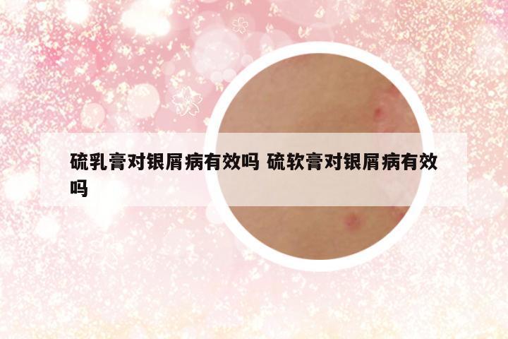 硫乳膏对银屑病有效吗 硫软膏对银屑病有效吗