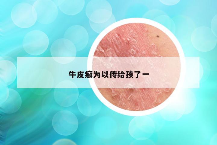 牛皮癣为以传给孩了一