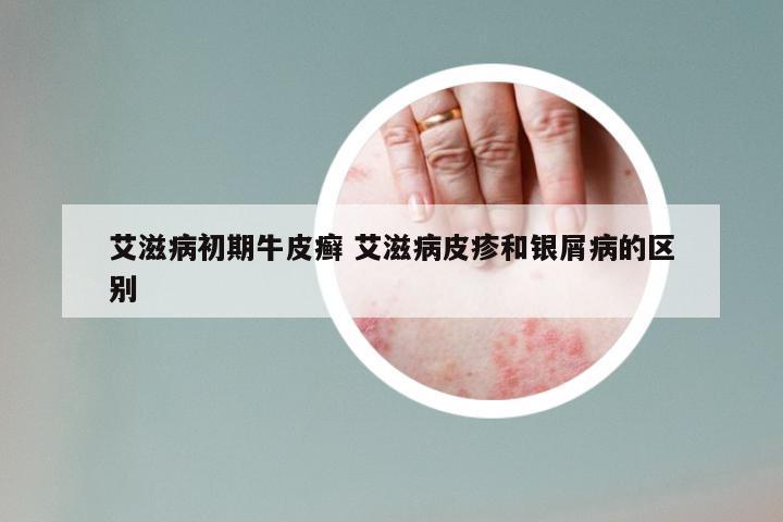 艾滋病初期牛皮癣 艾滋病皮疹和银屑病的区别