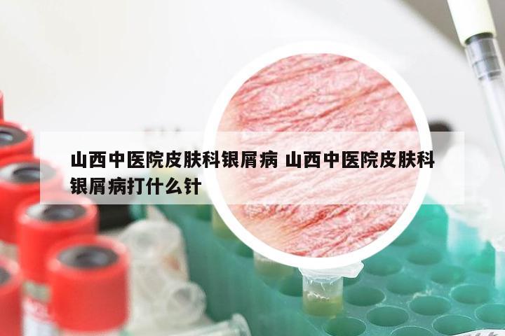 山西中医院皮肤科银屑病 山西中医院皮肤科银屑病打什么针
