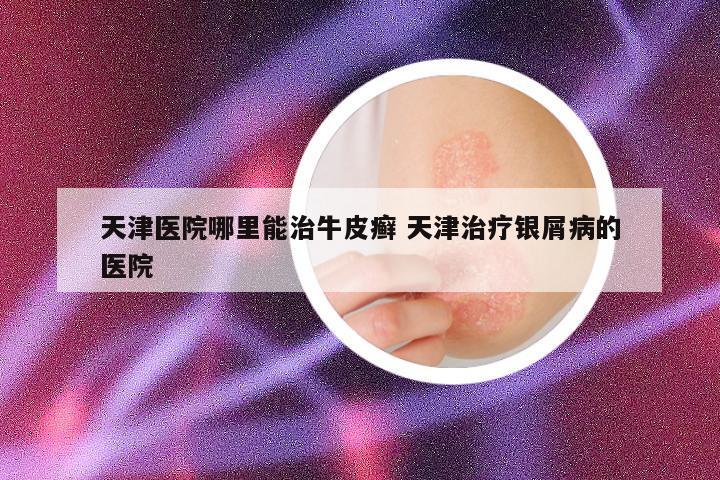 天津医院哪里能治牛皮癣 天津治疗银屑病的医院